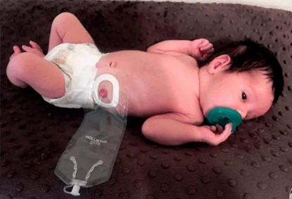 Anorectal Malformation Surgery in Children: Treatment, Cost & Types Explained
